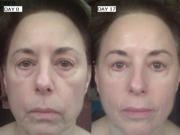 ageloc Before_After 1009