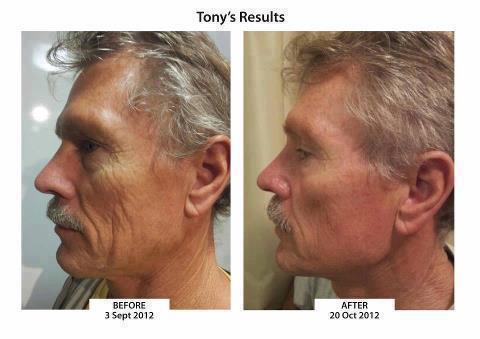 Anti-Aging-Before-and-After-Face-AgeLoc-Galvanic-Spa-1-and-a-half-months